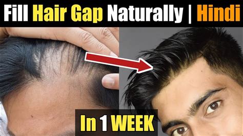 5 Steps To Fill Hair Gap Naturally How To Fill Hair Gap Naturally Regrow Hair Aditya