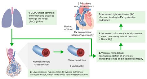 Cor Pulmonale Concise Medical Knowledge