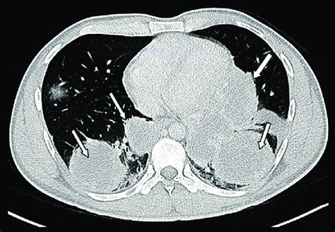 Ct Scan Of The Chest Shows Multiple Large Bilateral Lung Masses As Seen