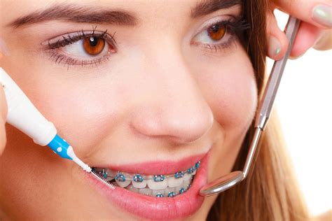 What to Do Once Your Braces Come Off?