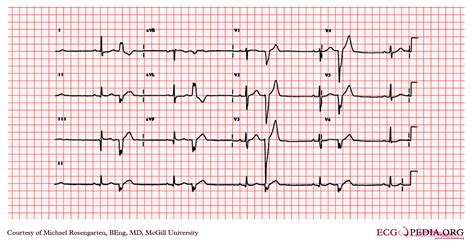 Ecg Showing Premature Ventricular Contractions With Occasional The