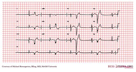 Ekg Patterns Premature Atrial Ventricular Contraction Vrogue Co