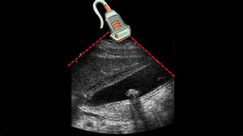 Ultrasound Of Gallbladder And Gallstone Youtube