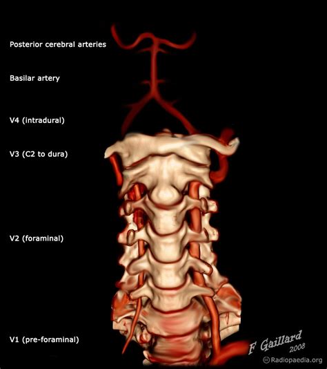 Severe twisting of arteries in the neck may lead to kinking which may occlude and hamper proper blood flow the two carotid arteries each on left and right side of neck supply blood to the brain. Vertebral artery | Image | Radiopaedia.org