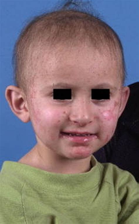 Image Acrodermatitis Enteropathica In A Child Msd Manual