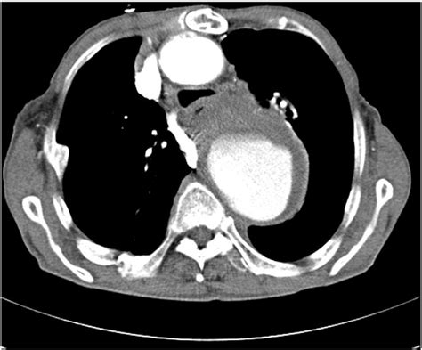 Chest Ct Showed An Enlarged Thoracic Aorta With An Intramural Thrombus