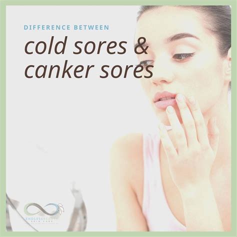 Difference Between Canker Sores And Cold Sores In 2021 Canker Sore