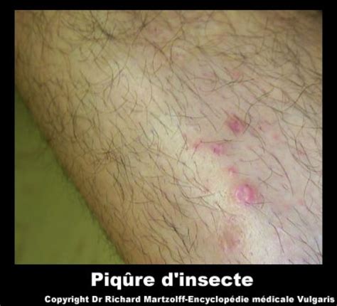 Image Photo Piqûre Dinsecte Infectieux Et Parasitologie Vulgaris