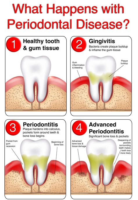 What Is Periodontal Disease Waterloo Heights Dental