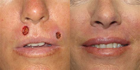 Lip Reconstruction Gallery Skin Cancer And Reconstructive Surgery Center