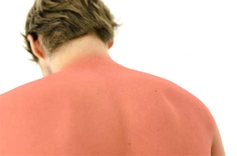 Suffering From Sunburn Heres How You Can Take Care Of It Through Home