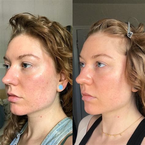 Banda Acne Scar Progress After 5 Months Of Curologytretinoin