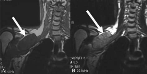 Figure 0009malignant Brachial Plexopathy A Pictorial Essay Of Mri