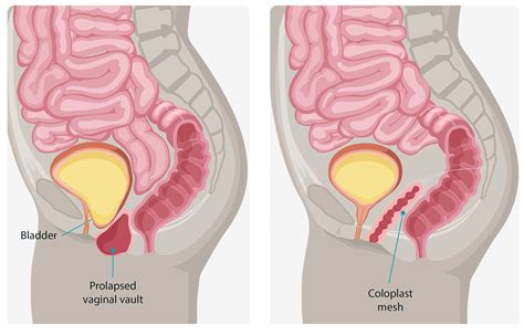 Surgical Management Of Pelvic Organ Prolapse Female By Karram Mickey M