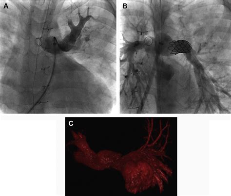 Pulmonary Artery Stenting Interventional Cardiology Clinics