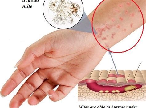 Scabies Rash Distribution