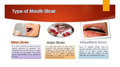 Ppt Treatment Of Mouth Ulcer By Must4care Powerpoint Presentation