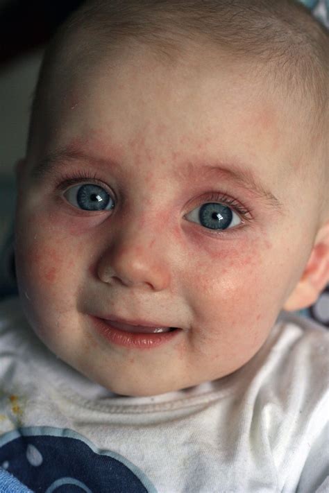 Treatments depend on the severity of the reaction. Baby Eczema: Diagnosement & Treatment - BabyAllergies.com