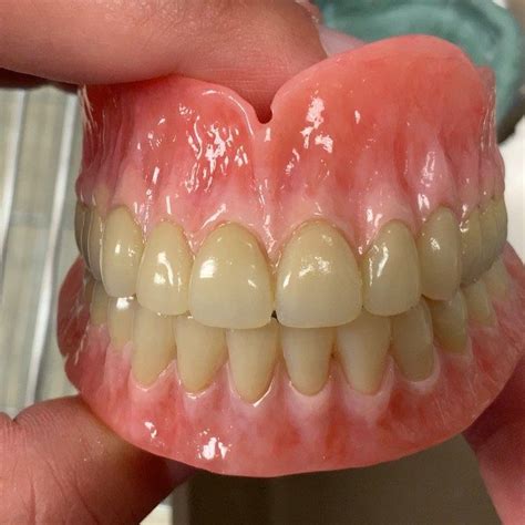 Lsk Signature Denture Complete Natural Look With Festooning Striation And Varied Tissue Color