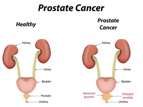 Learn more about common signs & symptoms. Young Men Also Vulnerable To Prostate Cancer - HealthTimes