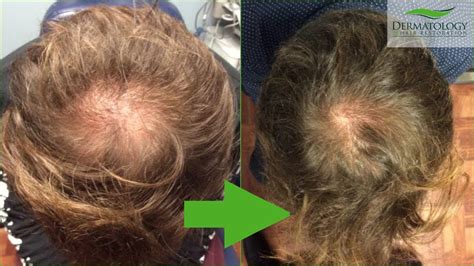 Prp Stem Cell Hair Loss Treatment Amazing Results In 4 Months Los Angeles Youtube