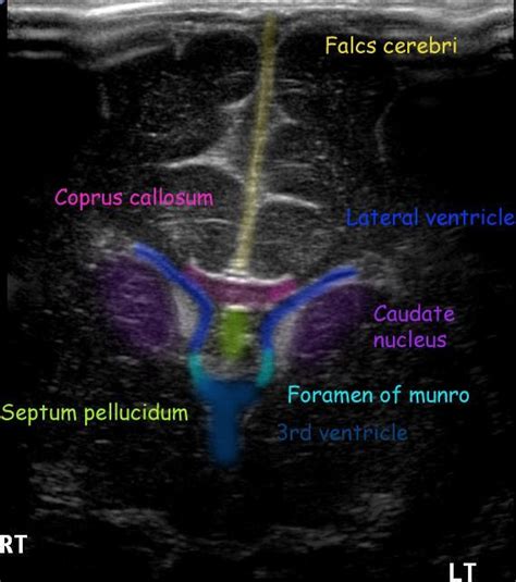 Normal Neonatal Brain Ultrasound Anatomy