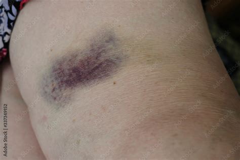 Big Bruise On The Knife Subcutaneous Trauma On Human Skin Painful