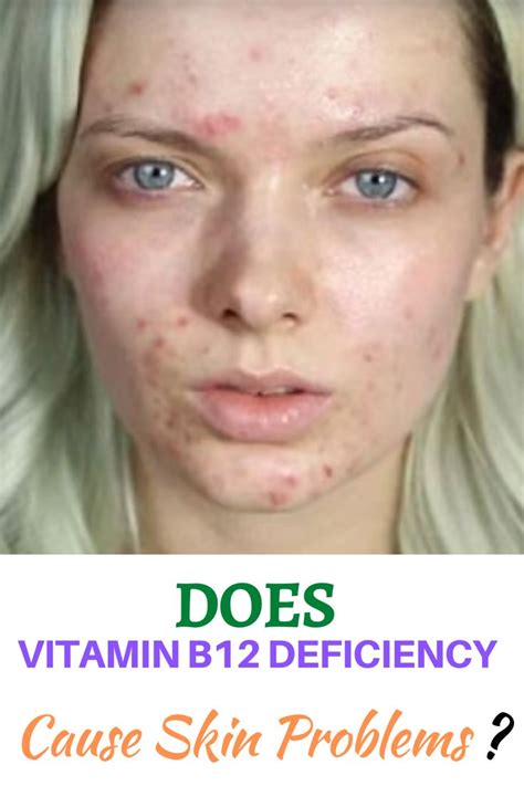 Does Vitamin B Deficiency Cause Skin Problems Skin Care Skin