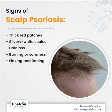 Psoriasis Causes And Risk Factors Psoriasis Scalp Psoriasis