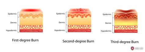 Burn Injury Depth And Grading Degrees Superficial Grepmed Gambaran