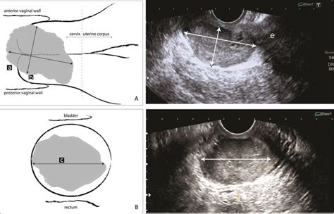 Transvaginal Ultrasound Noninvasive Method For The Prediction Of