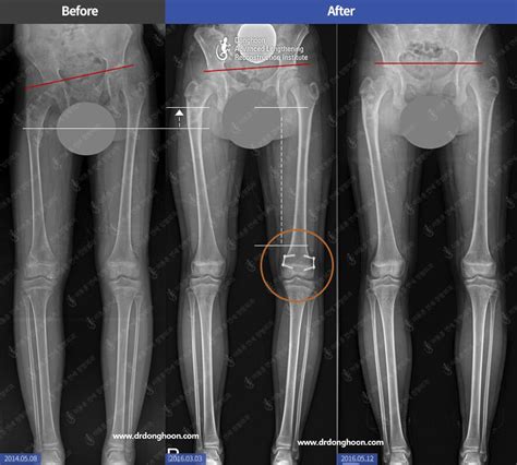 Leg Length Discrepancy Treatment