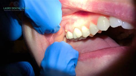 Tooth Abscess Drainage