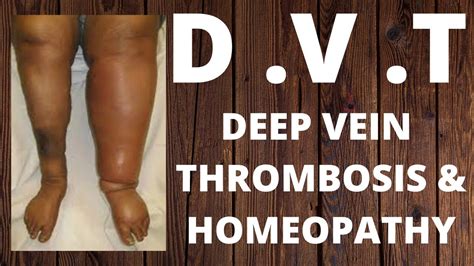 D V Tdeep Vein Thrombosishomeopathic Medicine For Deep Vein