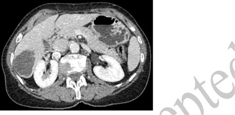Abdominal Ct Scan Showing A Hydatid Cyst In Segment Vi Of The Liver