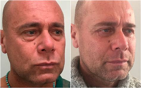 Eyelid Surgery Blepharoplasty Before And After Photos Uk Droopy Eye