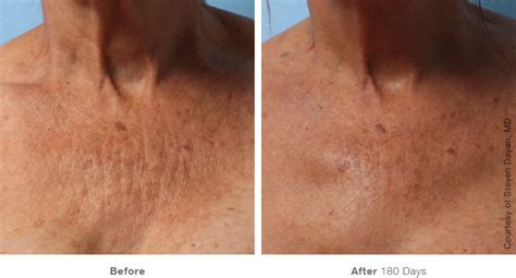 Ultherapy™ Non Surgical Skin Lifting Clarity Medspa