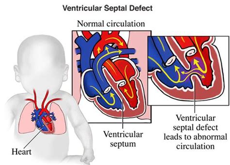 Ventricular Septal Defect Ultrasound