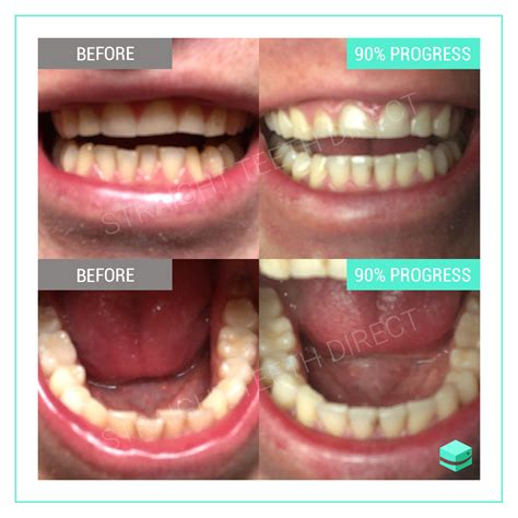 Invisalign invisalign braces are great for closing the gaps in your teeth as well as straightening crooked teeth. Teeth gaps: can they be closed without the use of braces?