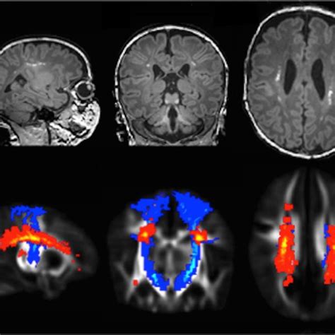 Consort Diagram Pwml Punctate White Matter Lesion Download