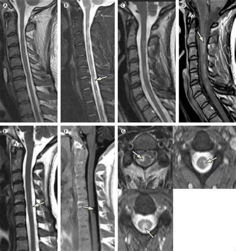 Spinal Cord Involvement In Multiple Sclerosis And Neuromyelitis Optica