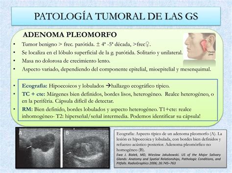Ppt Patología De Las Glándulas Salivales Hecha Fácil Powerpoint