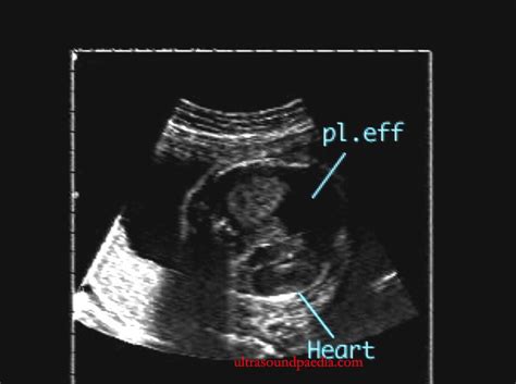 Fetal Pleural Effusion Ultrasound