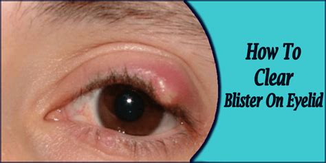 How To Clear Blister On Eyelid With Natural Home Remedies In 2 3 Weeks