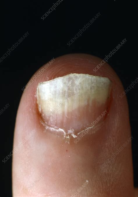 Fingernail Infected With Ringworm Stock Image M2700118 Science
