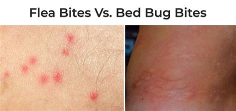 Whats The Difference Between Flea Bites And Bed Bug Bites Bedbugs