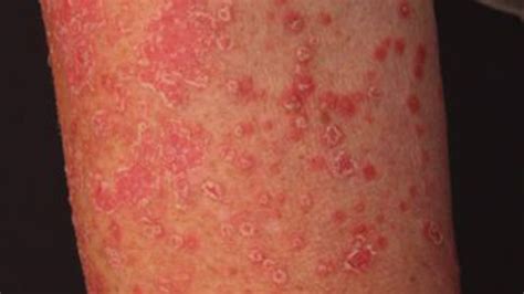 Guttate Psoriasis Causes Diagnosis And Treatments