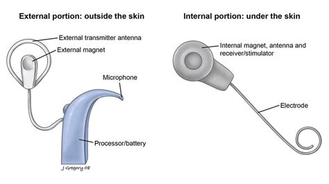 Cochlear Implant Diagram