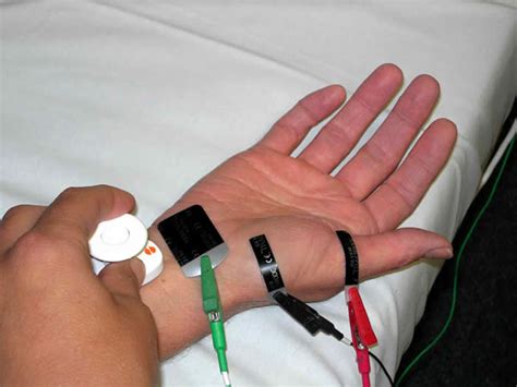 Emg Nerve Test On Hands What Does An Emg Diagnose Qeq