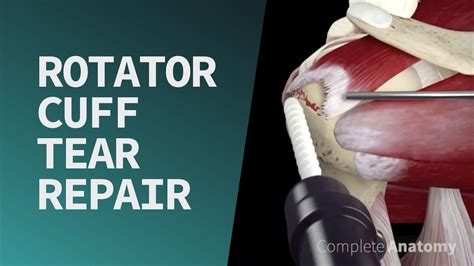 Rotator Cuff Tear Repair YouTube